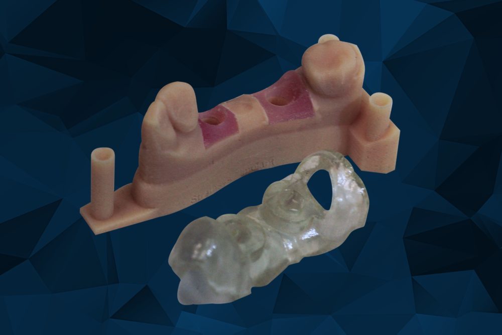 3D Printing Dental Implant Models for Surgical Guides