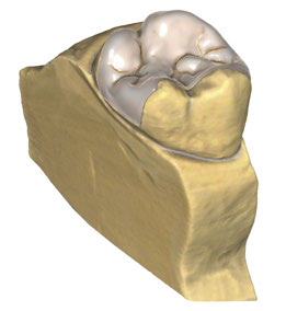 exocad dental cad inlays onlays application icon