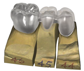 exocad DentalCAD bridge framework image