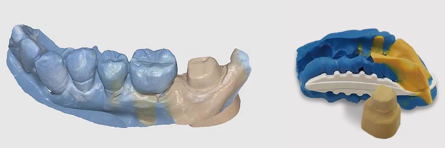double sided impression and plastor stump medit 3d dental scanning