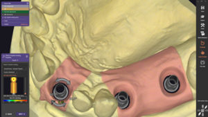 exocad_DentalCAD_Improved_Implant_Position_V2