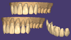 exocad_DentalCAD_Mockup_Tooth