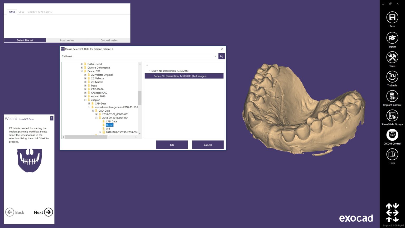 Exoplan by Exocad Implant Planning and Surgical Guide Software