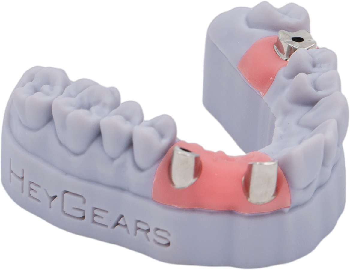 Implant Model-heygears