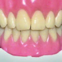 Image of a full denture milled with CORiTEC 50i